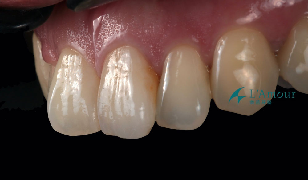 樂慕牙醫診所分享臨床案例(二)單顆全瓷冠案例 (由吳萬威院長提供) 猜猜是哪一顆牙齒呢?