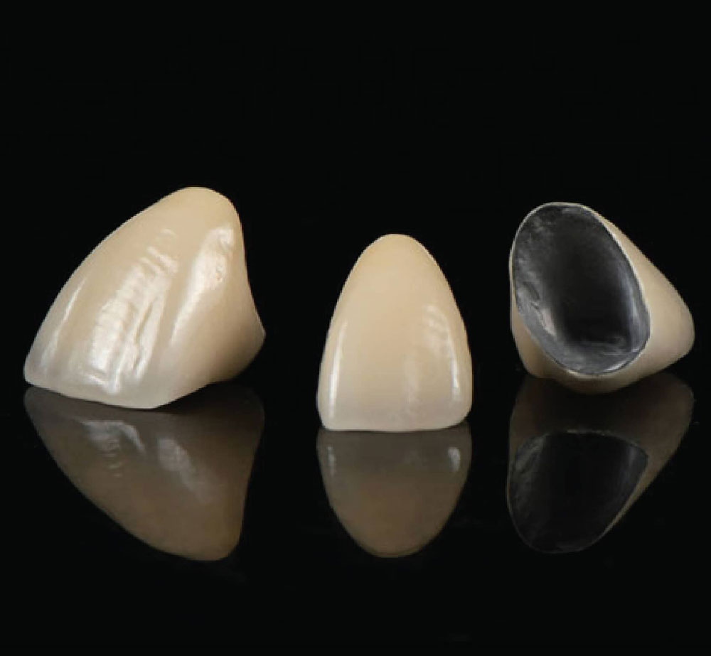 全瓷冠 近年來成為首選的高科技假牙材料