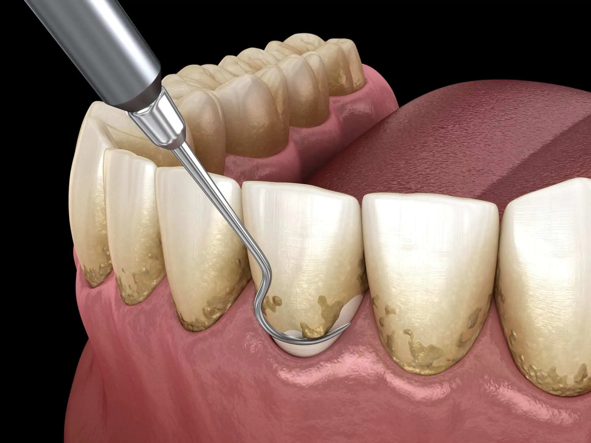 牙周病的患者也可能不適合快速植牙