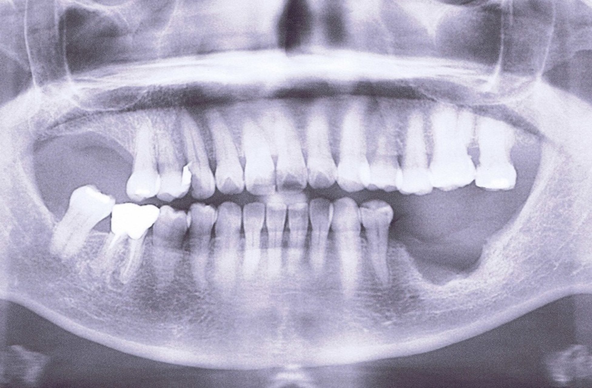 植牙術前評估檢查非常重要